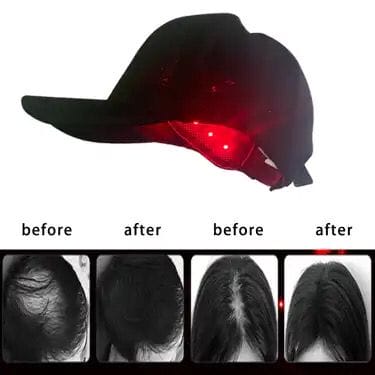 Terapie Laser Impotriva Caderii Parului - imagine 4